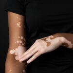 Why Vitiligo Patients Face A Mental Health Crisis, Not Just A Skin Condition