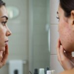 A Simple Guide On How To Treat Acne Scars At Home Naturally With DIY Hacks